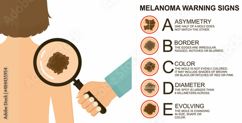 Diagnosis of skin cancer. Melanoma warning signs. Dermatological screening. UVB prevention of squamous cell treatment. Basal test. ABCDEs of skin cancer screening.  photo