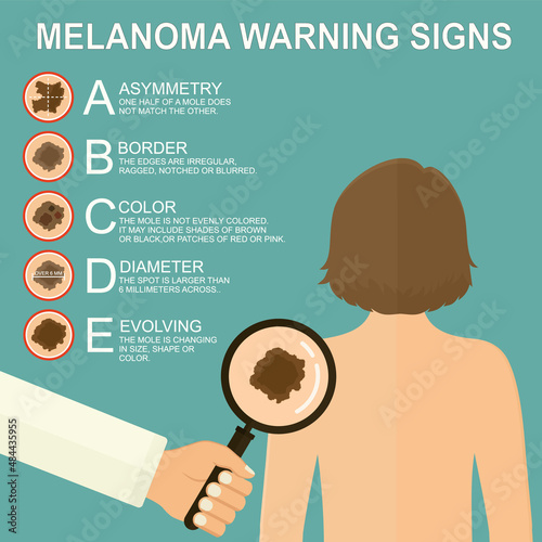 Diagnosis of skin cancer. Melanoma warning signs. Dermatological screening. UVB prevention of squamous cell treatment. Basal test. ABCDEs of skin cancer screening. 