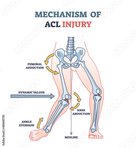Mechanism of ACL injury as knee trauma anatomical explanation outline diagram. Labeled educational anterior cruciate ligament twist, abduction, ankle eversion and femoral adduction vector illustration photo
