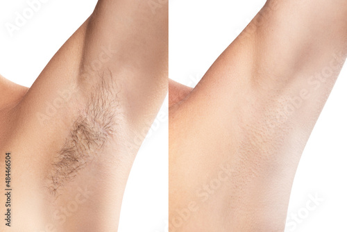 Comparison of female armpit after hair removal photo