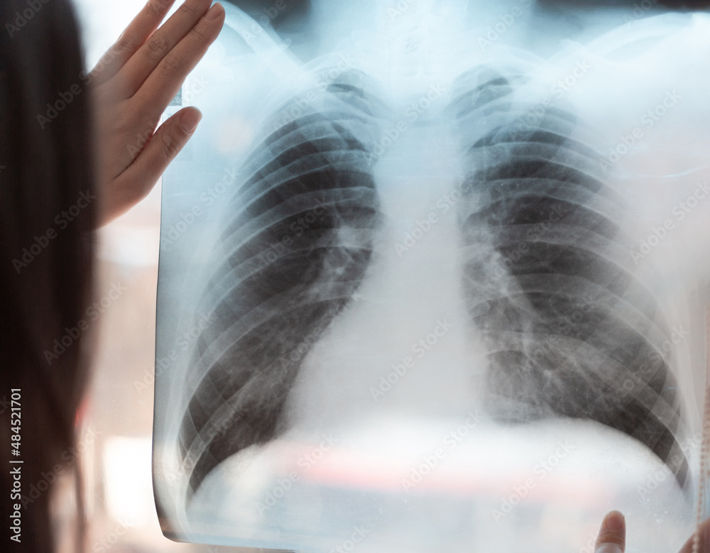 Xray of the lungs in the hands of a pneumologist. A lung shot shows a