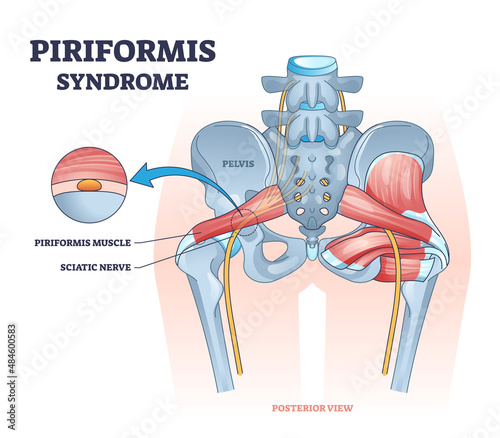 Piriformis syndrome and sciatic nerve compression pain cause outline diagram. Labeled educational medical body back disease explanation with anatomical skeletal and muscle scheme vector illustration.
