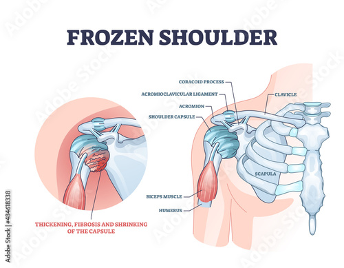 Frozen shoulder condition or adhesive capsulitis syndrome outline diagram. Labeled educational medical diagnosis with pain and stiffness around body upper part with movement limits vector illustration photo