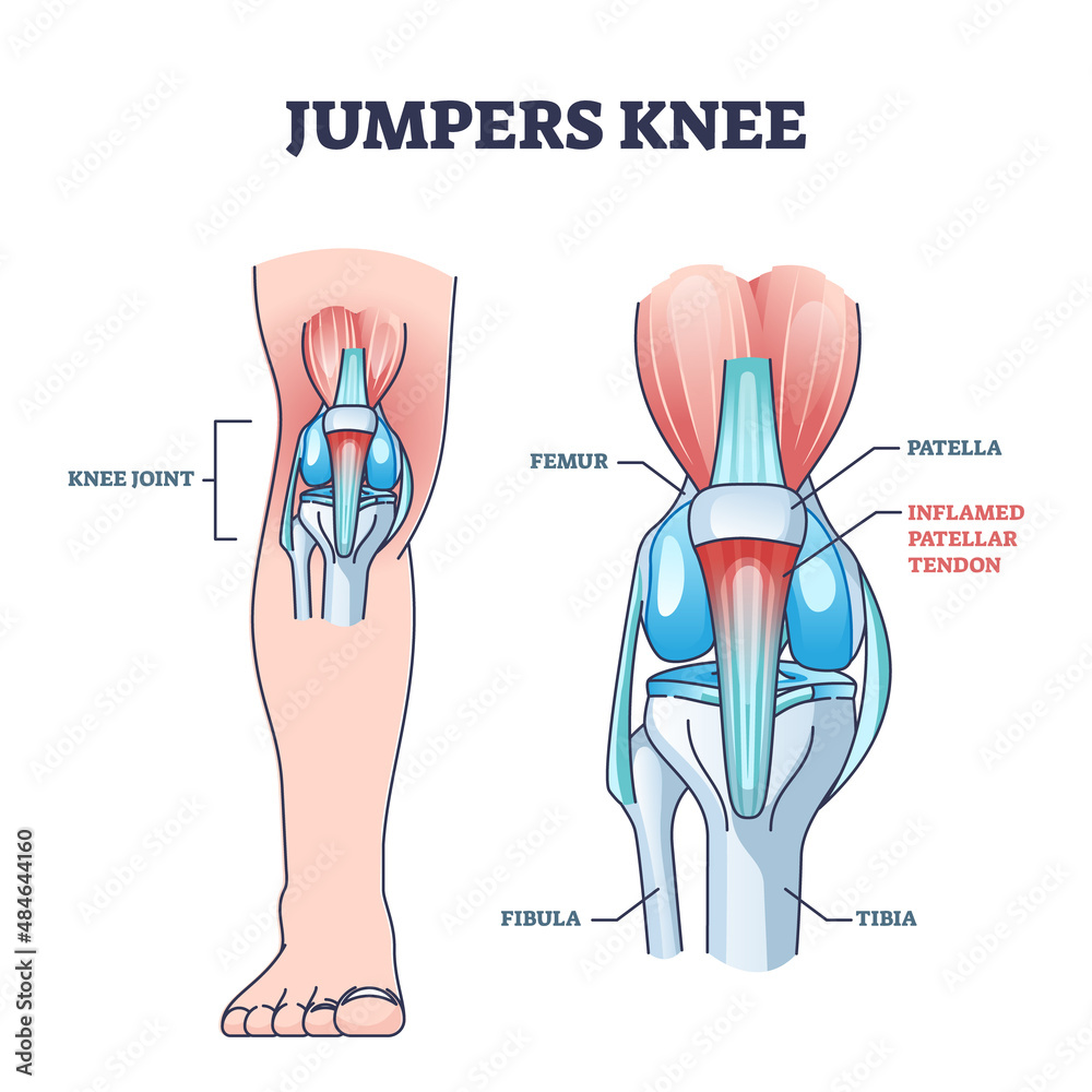 Jumpers knee or patellar tendonitis tendon bone inflammation outline diagram. Labeled