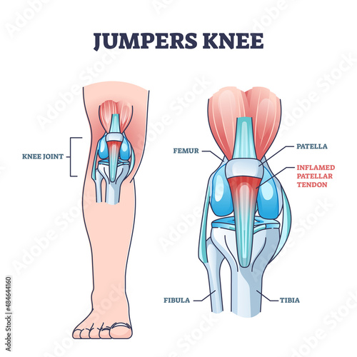 Jumpers knee or patellar tendonitis tendon bone inflammation outline diagram. Labeled educational anatomical scheme with leg skeletal structure vector illustration. Inflamed and painful joint problem.