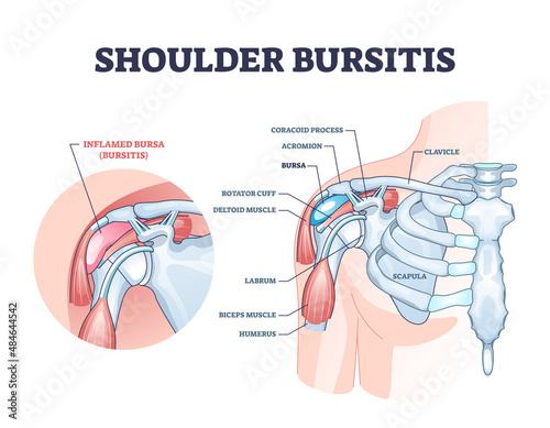 Shoulder bursitis as medical painful bursa inflammation outline diagram. Labeled educational disease explanation with anatomical structure and inner body medical injury description vector illustration
