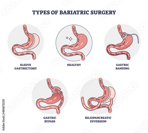 Types of bariatric surgery and stomach reduction control outline diagram. Labeled educational scheme with digestive gastric operation methods vector illustration. Medical procedure process examples.