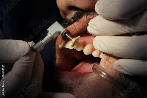 Rubber disc for polishing the resin of an upper canine. Dental procedure. Dentist hands performing procedure.
