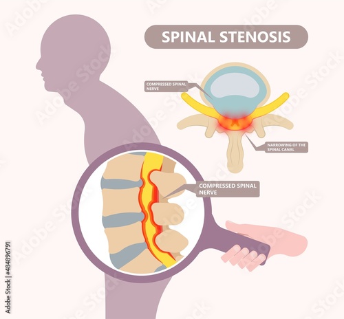 Spinal stenosis a narrowing of the spaces of the spine that causes lower back pain annulus nucleus bulged older cord muscle weakness neck cauda equina injury cushioning vertebrae disk bone photo