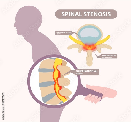 Spinal stenosis a narrowing of the spaces of the spine that causes lower back pain annulus nucleus bulged older cord muscle weakness neck cauda equina injury cushioning vertebrae disk bone