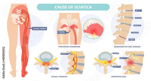 Sciatica nerve pain lower back through hips to leg	 photo