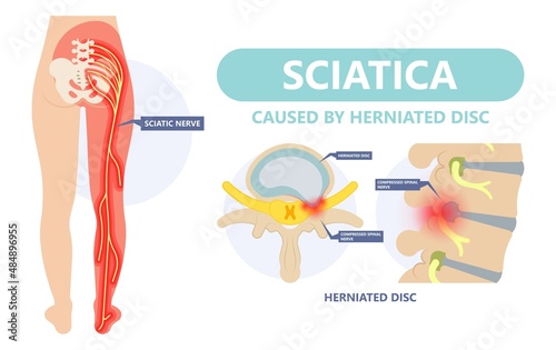 Sciatica nerve pain lower back through hips to leg	