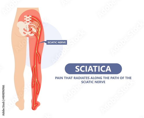 Sciatica nerve pain lower back through hips to leg	 photo