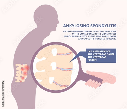 Ankylosing Spondylitis osteoporosis Skeletal pelvis Stiffness chronic knee ankle spondylolysis