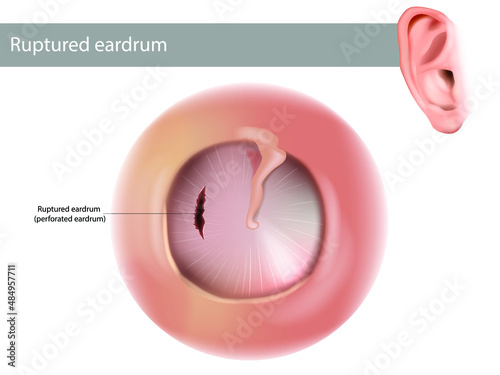 Ruptured eardrum or perforated eardrum. Tympanic membrane perforation. Hole in the eardrum.  photo
