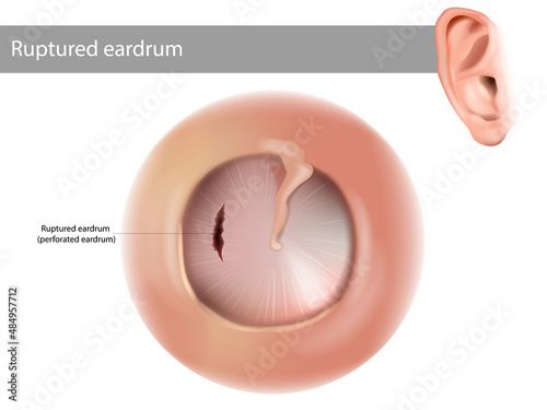 Ruptured eardrum or perforated eardrum. Tympanic membrane perforation. photo