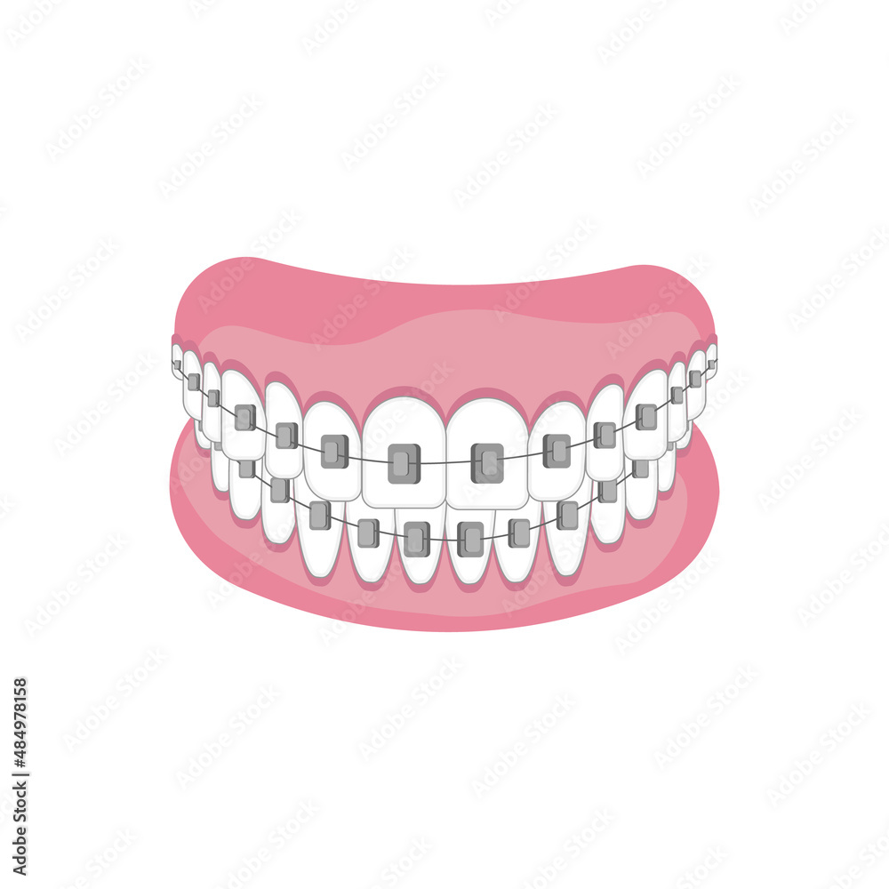 Teeth with braces on white background. Alignment of bite of teeth, correct bite of teeth. Dental jaw with braces, Dental braces. Vector illustration