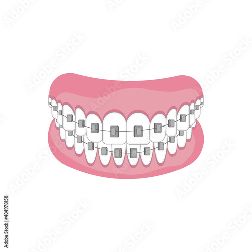 Obraz na płótnie Teeth with braces on white background. Alignment of bite of teeth, correct bite of teeth. Dental jaw with braces, Dental braces. Vector illustration w salonie