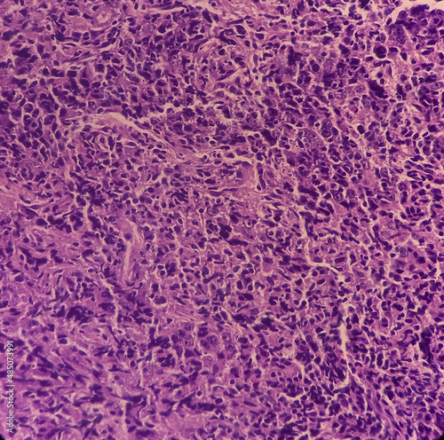 Nasopharyngeal carcinoma, nasopharynx cancer, microscopic show malignant tumor of atypical epithelial cells with prominent nuclei, most common cancer originating in the nasopharynx. photo