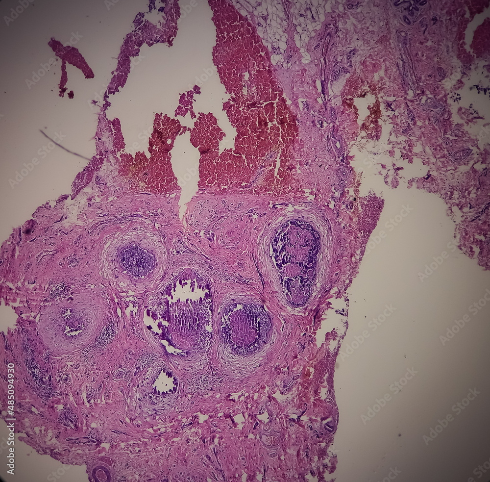 Nipple ulcer biopsy Paget's disease of the nipple, microscopic image