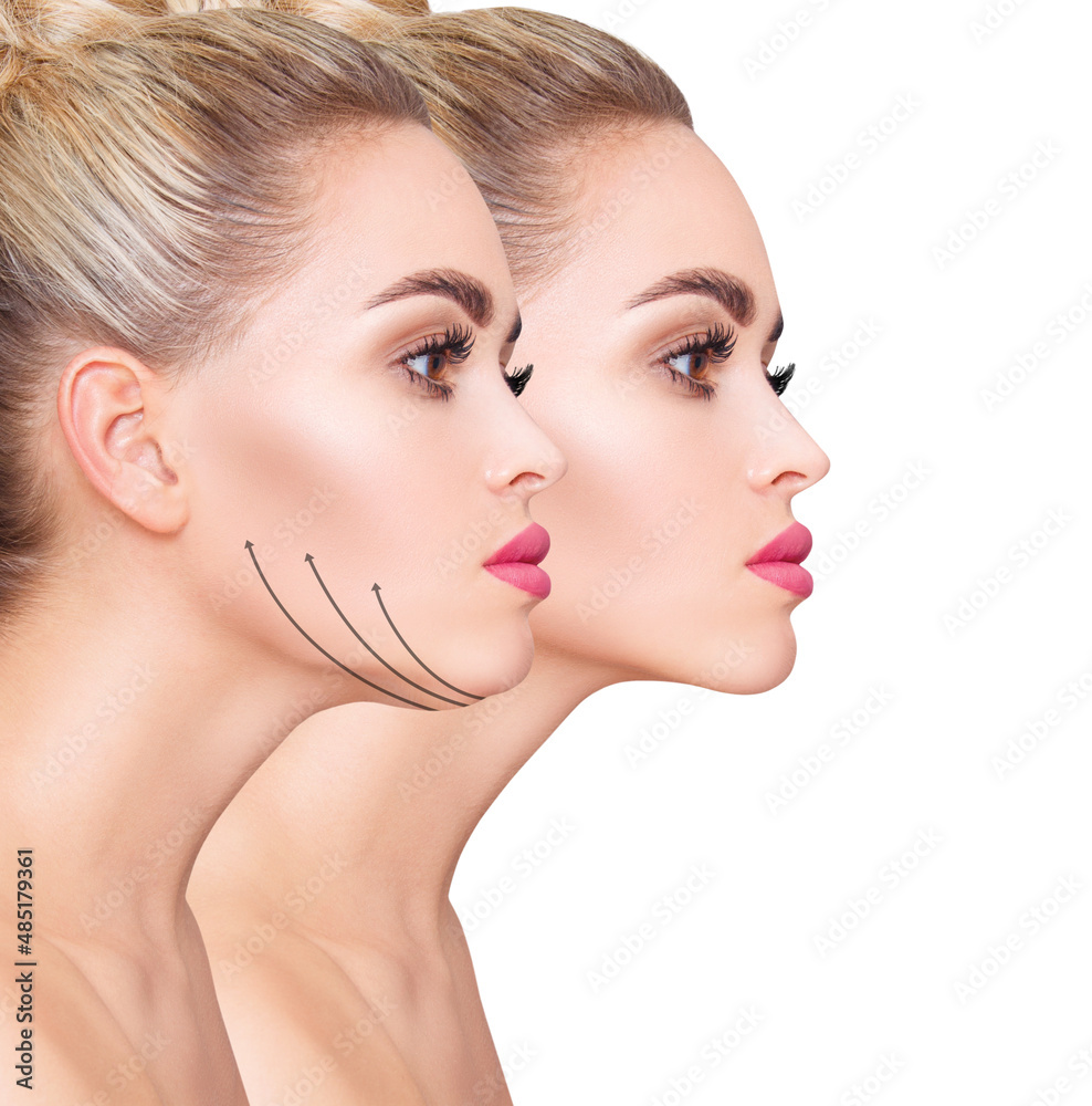 Fototapeta premium Beautiful woman before and after fat chin correction.