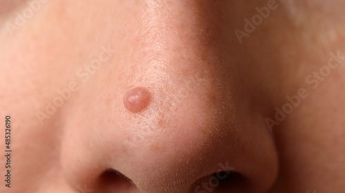 Mole or nevus on the nose on woman's face. Closeup. photo