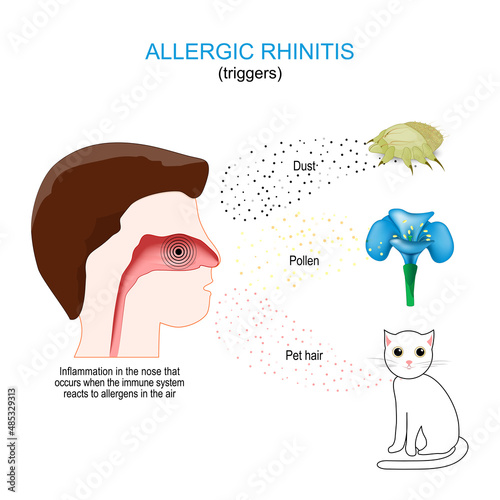 Allergic rhinitis triggers