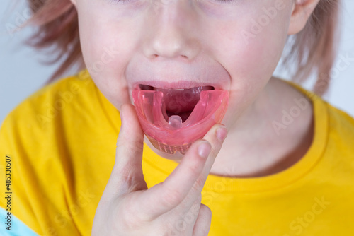 Adorable little girl puts myofunctional trainer in the mouth photo