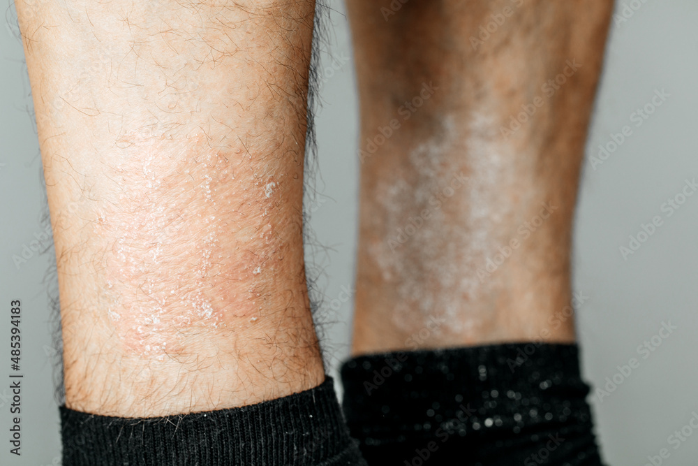 Acute psoriasis na is an autoimmune incurable dermatological skin