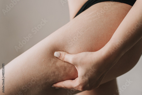 cellulite on the skin