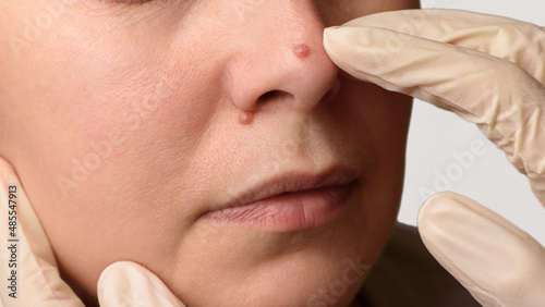 Diagnosis of skin mole or nevus on woman's face. Doctor's hands in surgical gloves examining nevi on nose. Checking moles concept. Closeup.