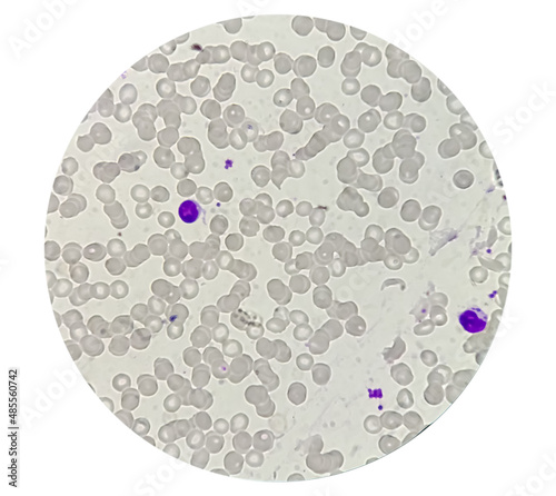 Blood smear microscopic show Reactive lymphocytes and Neutropenia.