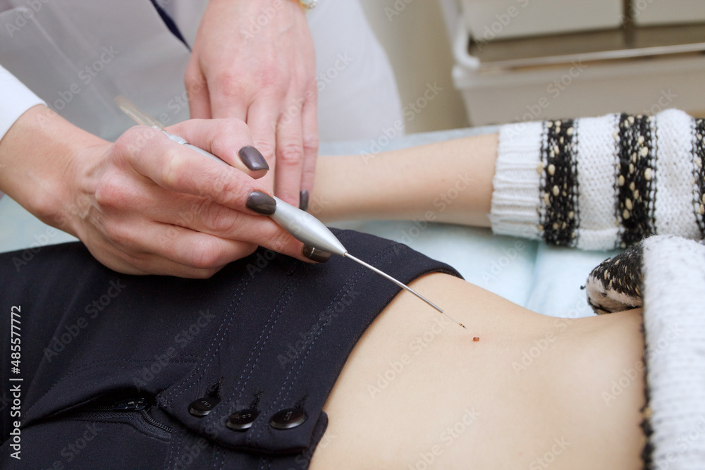 Cosmetologist performs laser wart removal procedure Cosmetologist performs laser wart removal procedure