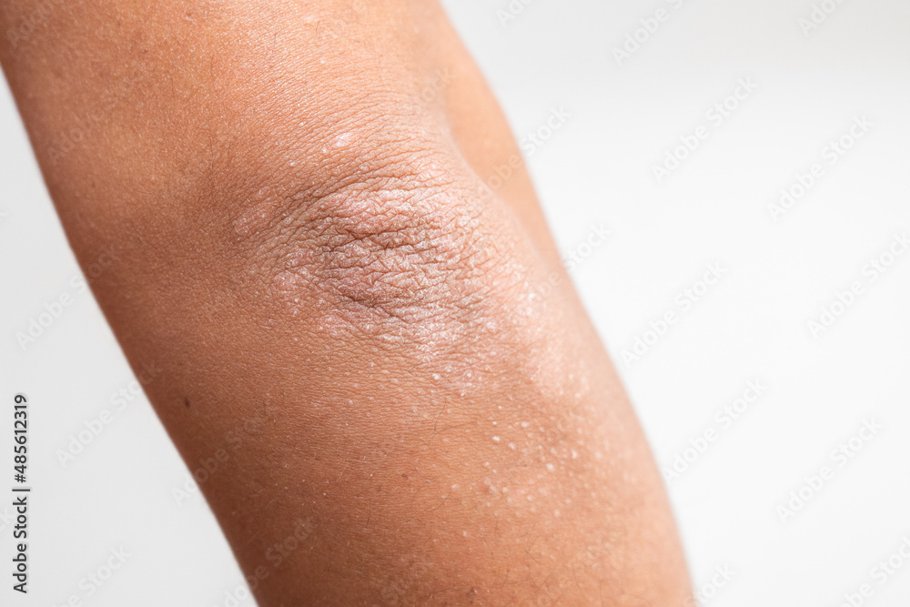 Fototapeta premium BRAZO DE HOMBRE CON PSORIASIS