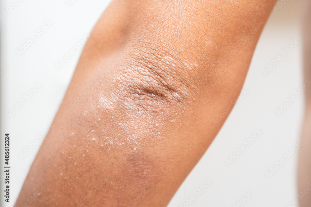 Fototapeta premium CODO DE HOMBRE CON PSORIASIS