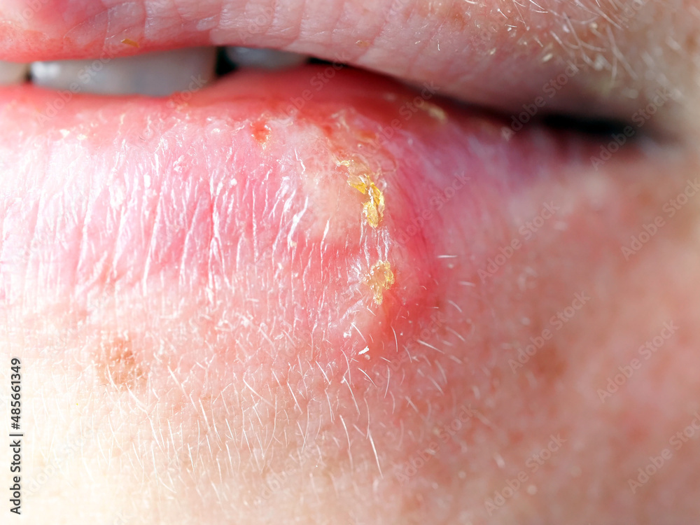 Fototapeta premium herpes on the lip of a woman