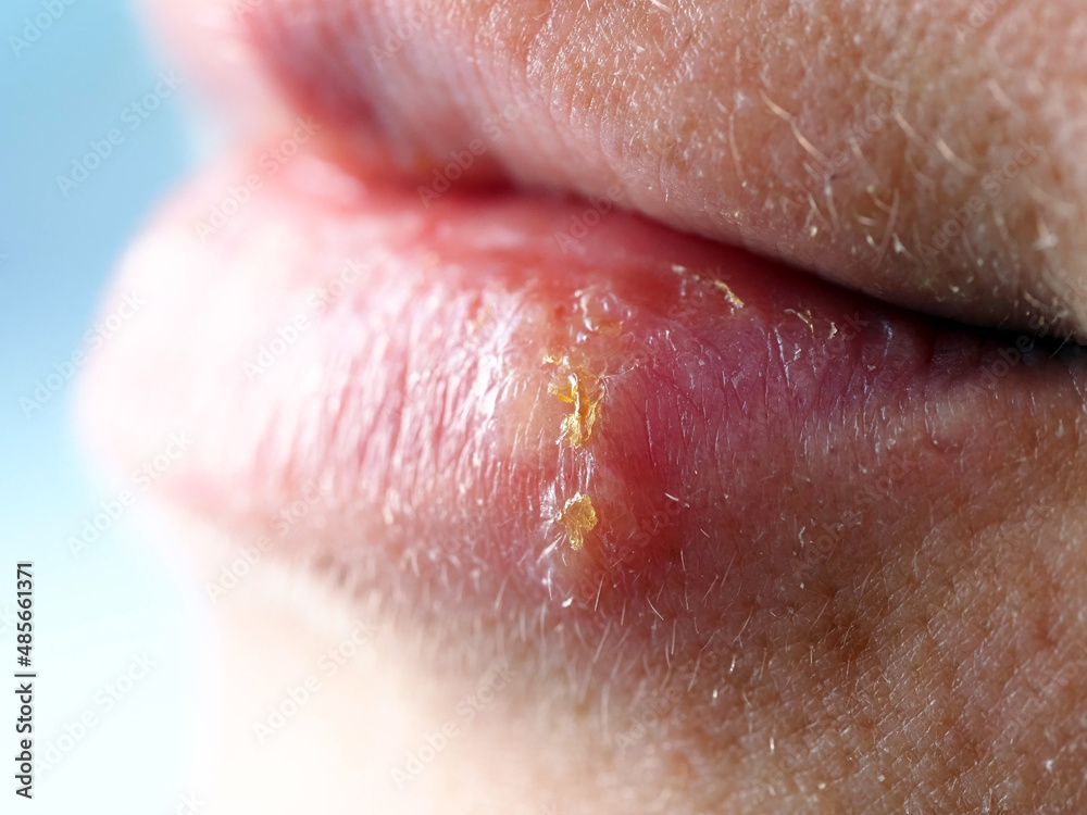 Obraz premium herpes on the lip of a woman