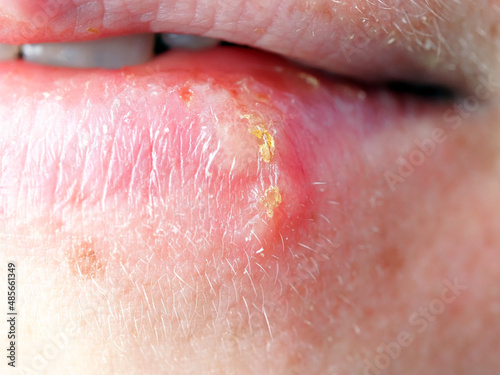 herpes on the lip of a woman
