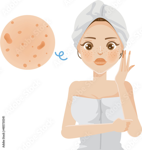 women freckles on face skin. girl wrapped in towel