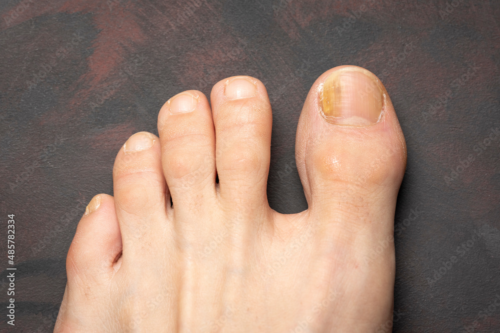 Toenails with fungus problems,Onychomycosis, also known as tinea unguium,  is a fungal infection of the nail, dark background. Stock Photo