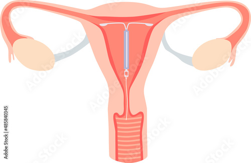 The intrauterine device in the uterus. Female contraception.