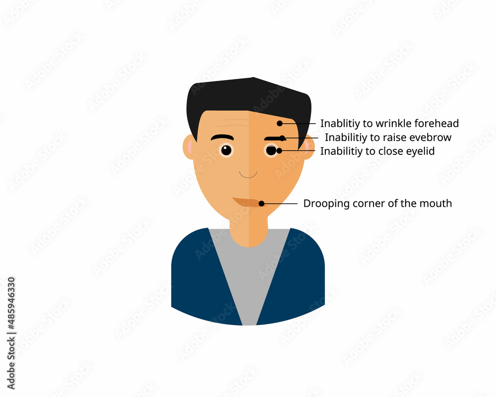 Bell’s palsy symptom of the disease Bell’s palsy symptom of the disease