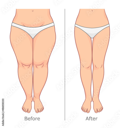 Woman legs weight loss vector illustration. Before and after. 