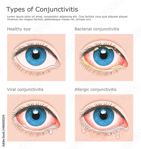 Three types of conjunctivitis and healthy eye medical vector illustration.  photo