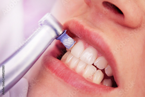 Close-up professionelle Zahnreinigung / die Zähne einer Frau werden poliert photo