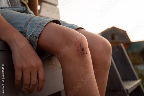 skin injury - scab and abrasion on knee of teenage boy photo