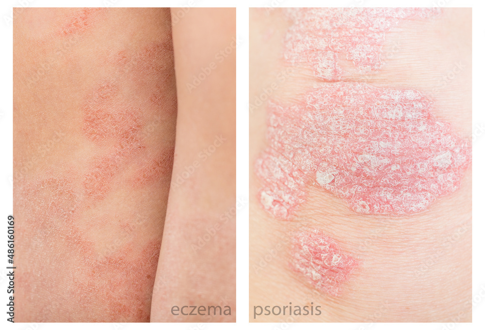 Close up difference between Psoriasis and Eczema, atopic dermatitis