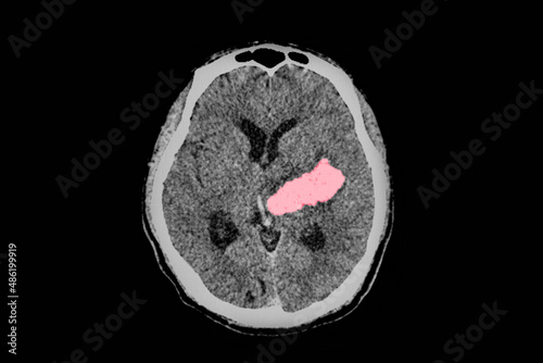 A computer tomography image of brain and skull showing large intracerebral hemorrhage or hemorrhagic stroke.