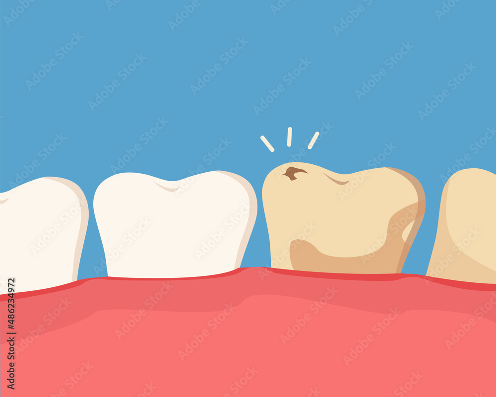 Dental cavity concept. Damaged teeth with caries. Vector cartoon ...