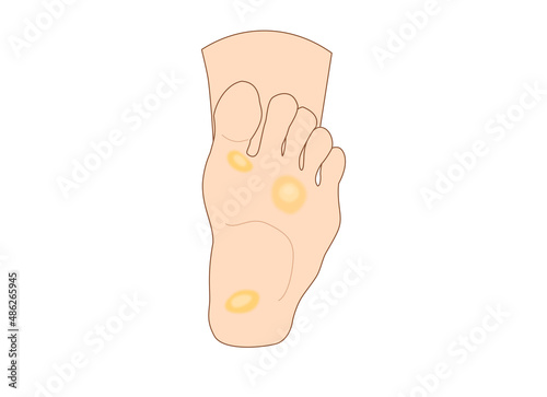 Foot callus